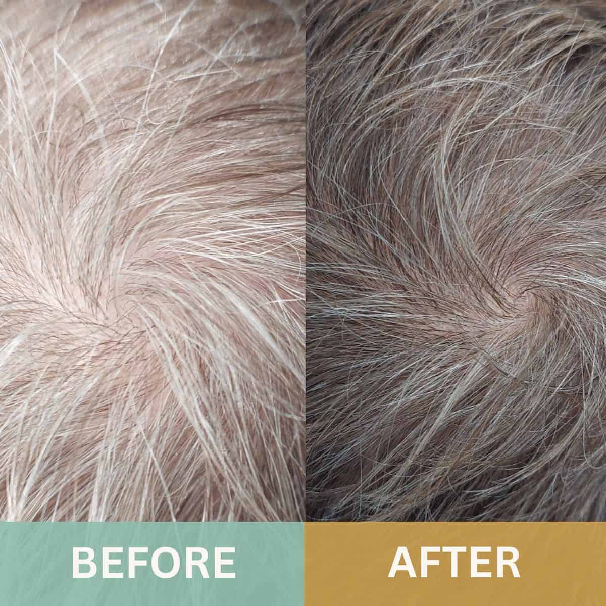 Male before and after scalp micropigmentation treatment cosmetically restoring the visible signs of hair loss and thinning. Re-creating a the natural appearance of hair follicles through PMU.