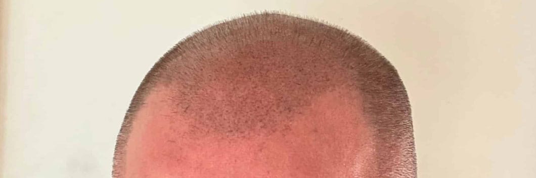 Happy customer after New confidence PMU by Kerry scalp micropigmentation treatment in Leigh on Sea, qualified PMU specialist for thinning hair, receding hairlines, alopecia for both men and women.